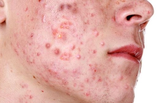 Acne en puistjes op wang