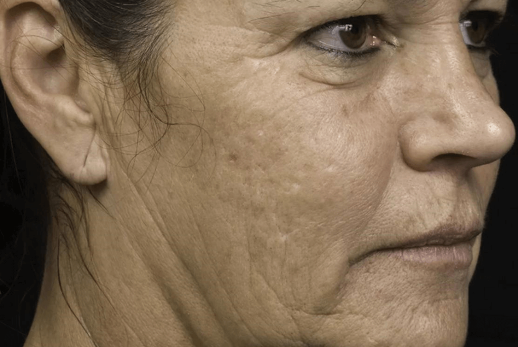 Doffe huid bij vrouw